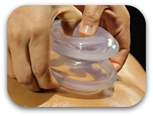 cupping2.png